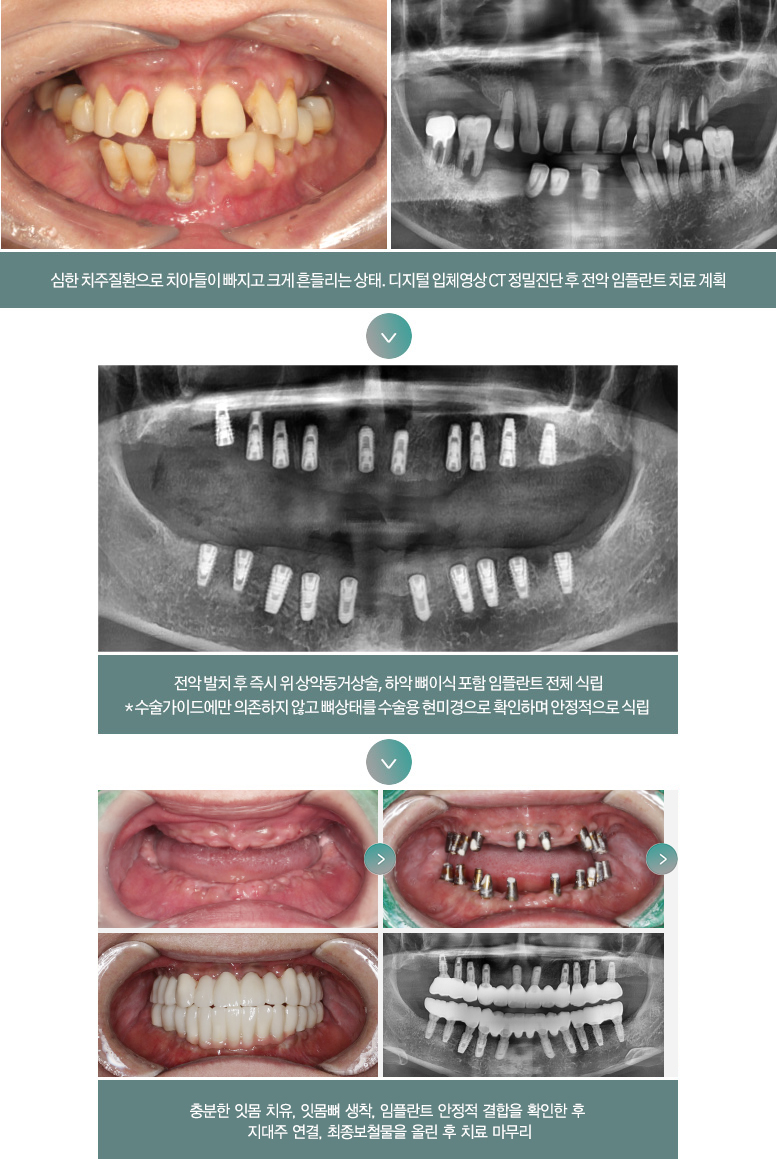 심한 치주질환으로 치아들이 빠지고 크게 흔들리는 상태. 디지털 입체영상 CT 정밀진단 후 전악 임플란트 치료 계획 > 전악 발치 후 즉시 위 상악동거상술, 하악 뼈이식 포함 임플란트 전체 식립(*수술가이드에만 의존하지 않고 뼈상태를 수술용 현미경으로 확인하며 안정적으로 식립) > 충분한 잇몸 치유, 잇몸뼈 생착, 임플란트 안정적 결합을 확인한 후 지대주 연결, 쵲오보철물을 올린 후 치료 마무리