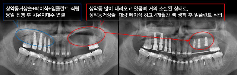 상악동거상술+뼈이식+임플란트 식립 당일 진행 후 치유지대주 연결 / 상악동 많이 내려오고 잇몸뼈 거의 소실된 상태로, 상악동거상술+대량 뼈이식 하고 4개월간 뼈 생착 후 임플란트 식립