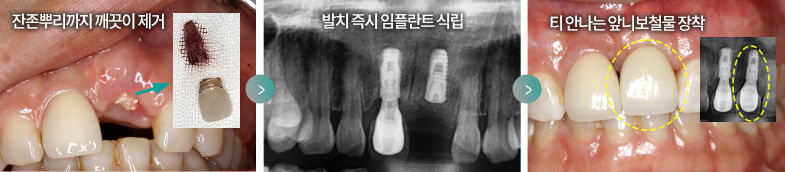 잔존 뿌리까지 깨끗이 제거 > 발치 즉시 임플란트 식립 > 티 안나는 앞니 보철물 장착
