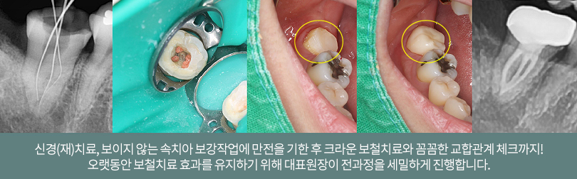 신경(재)치료, 보이지 않는 속치아 보강작업에 만전을 기한 후 크라운 보철치료와 꼼꼼한 교합관계 체크까지! 오랫동안 보철치료 효괄르 유지하기 위해 대표원장이 전 과정을 세밀하게 진행합니다.
