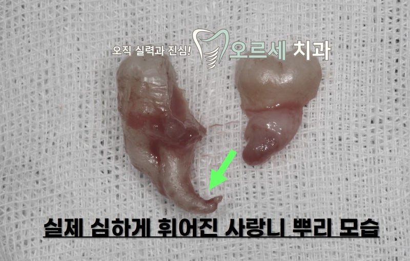 강남역에서 사랑니 발치 고민된다면, … 썸네일