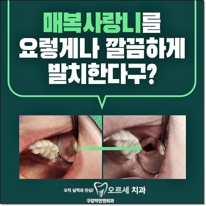 발치뜻과 필요성, 치과에서 꼭 알아둬… 썸네일