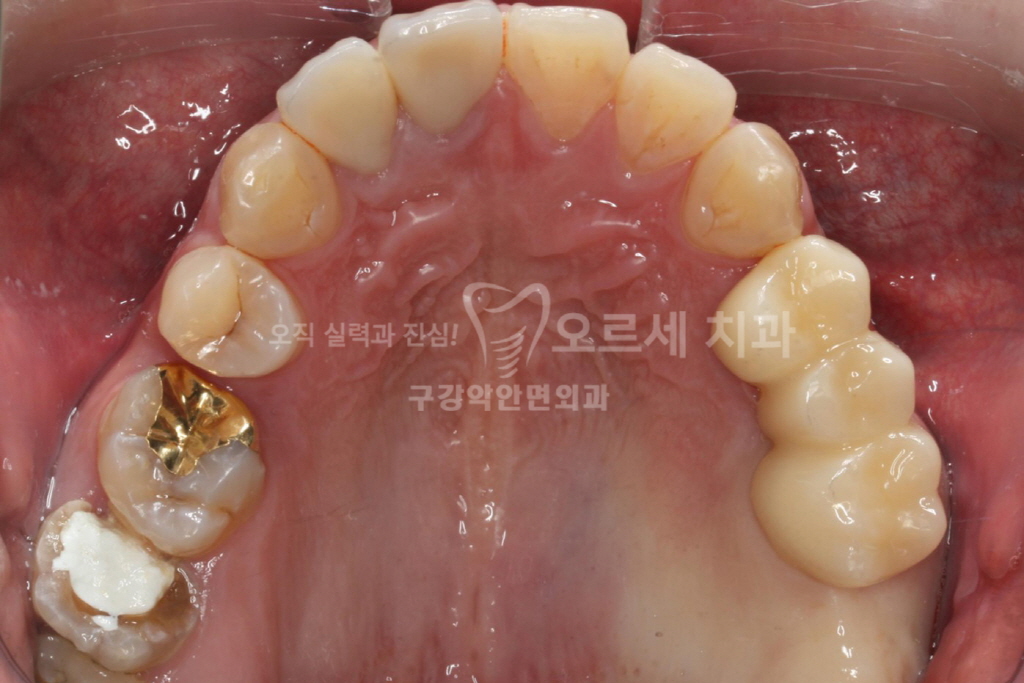 서초동 임플란트 맞춤 기둥과 치아색 … 썸네일