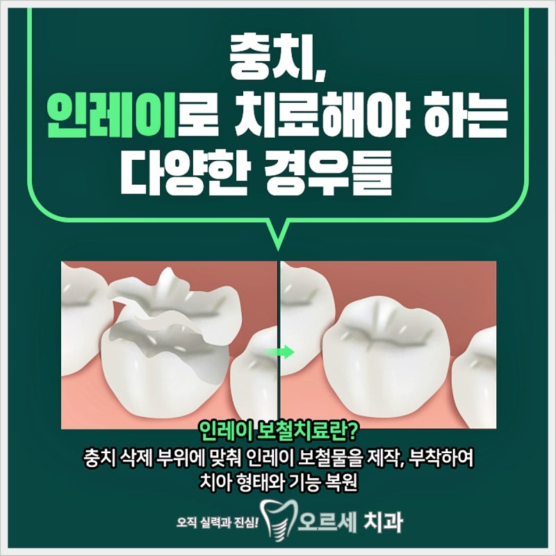치아 인레이 가격 종류별 특징과 내게… 썸네일