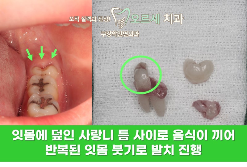 사랑니 발치하면 직장 생활에 지장이 … 썸네일